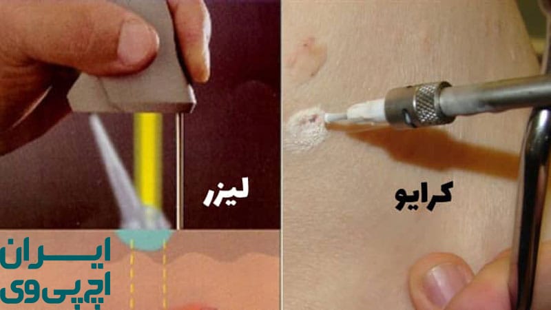 مقایسه میزان اثربخشی و احتمال بازگشت زگیل HPV با فریز یا لیزر