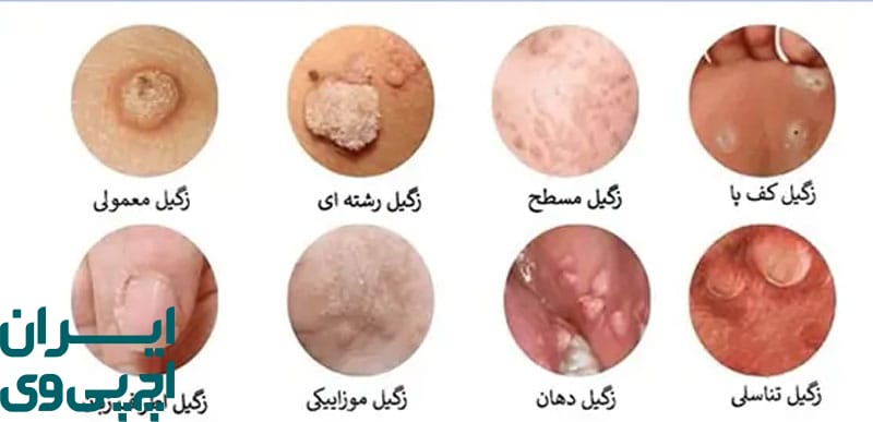 نحوه انتقال زگیل تناسلی و زگیل پوستی و تفاوت منشأ عفونت