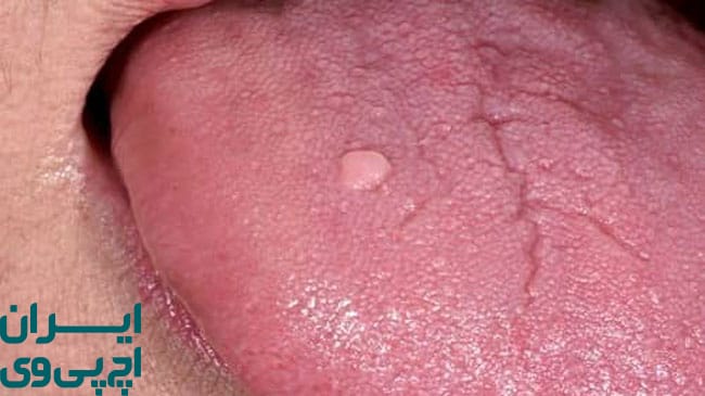 نشانه‌ های اولیه HPV دهانی در دهان و گلو