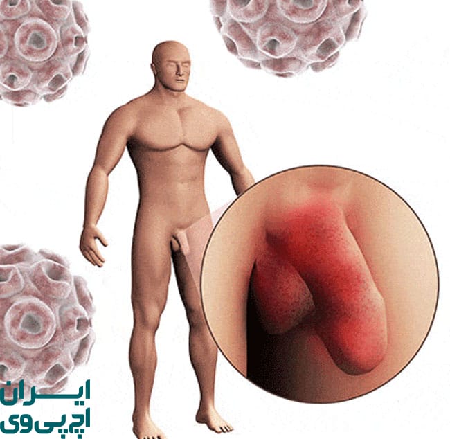 نشانه‌ های ظاهری زگیل تناسلی در مردان