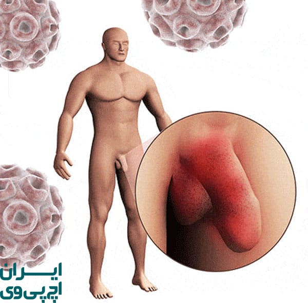 نقش ختنه در کاهش خطر HPV