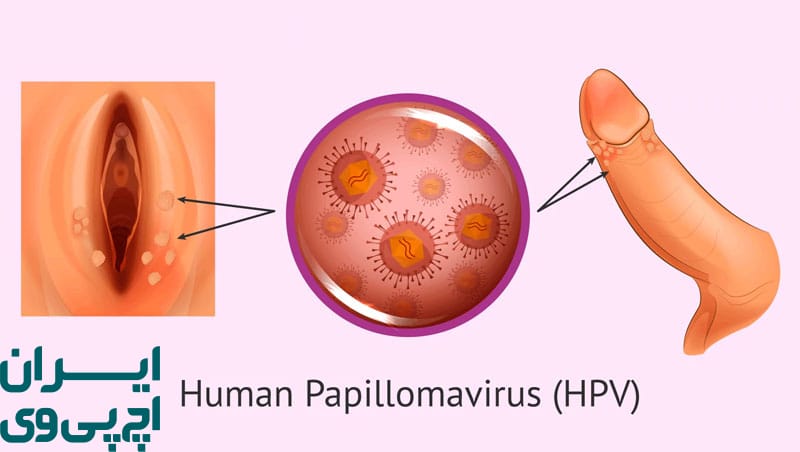 نقش واکسیناسیون در کنار رابطه محافظت‌ شده HPV