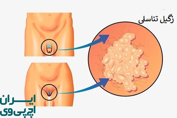 پرهیز از تماس مستقیم پوستی با زگیل تناسلی