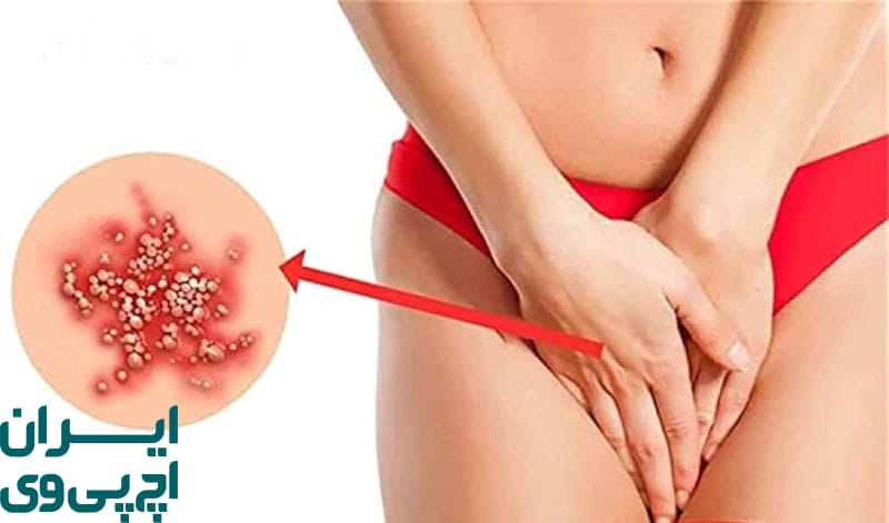 پرهیزهای روزمره در دوران نقاهت HPV