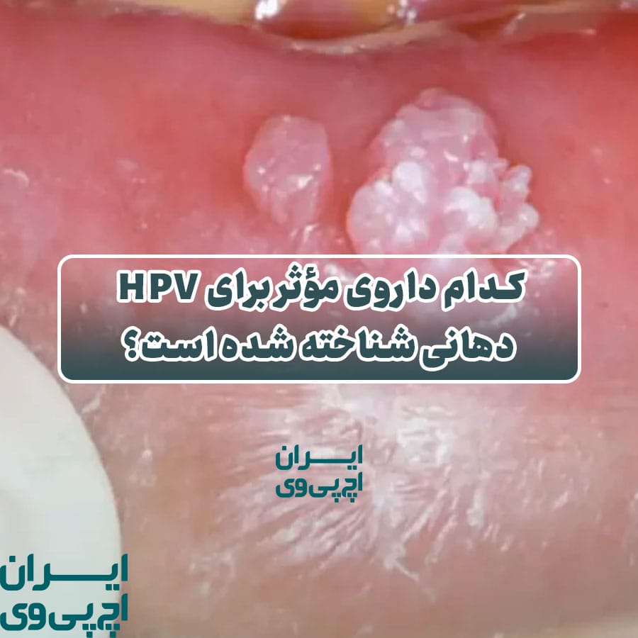 کدام داروی مؤثر برای HPV دهانی شناخته شده است؟