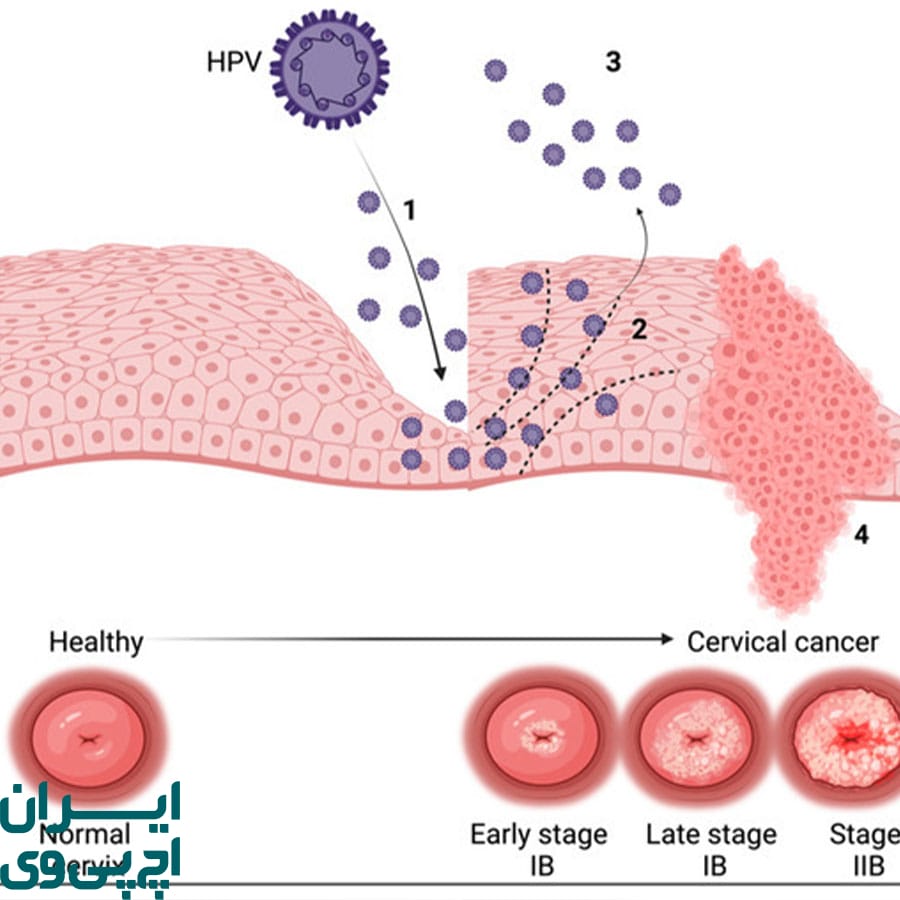 بررسی مکمل AHCC و کاهش عوامل خطر سرطان دهانه رحم